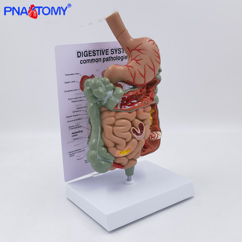 消化管モデル 病気の消化器系 胃の解剖図 小腸と大腸 結腸解剖モデル 教育ツール