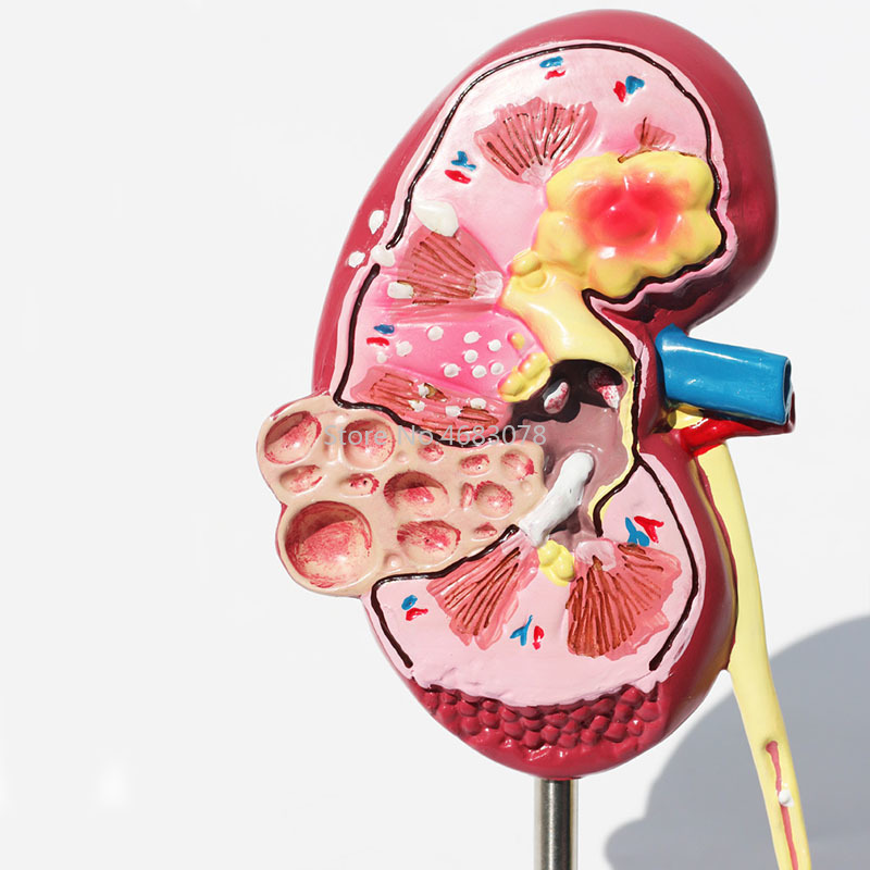 人体臓器医学用腎臓解剖病変腎臓モデル人体解剖学教材