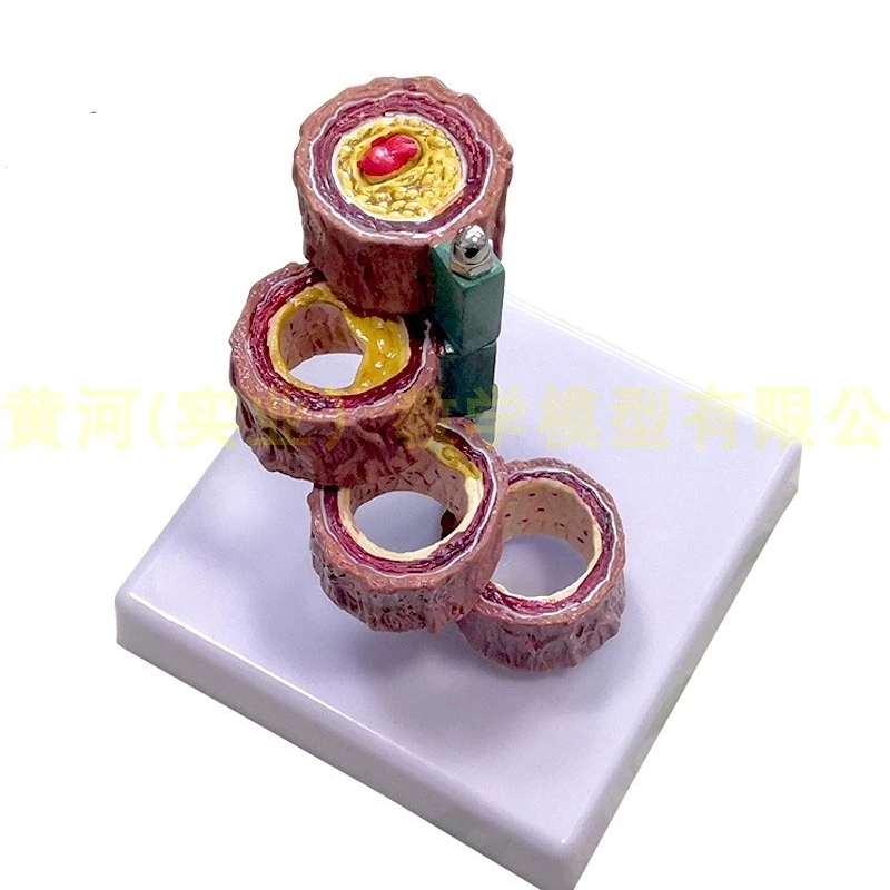 血栓症ヒト分枝/アテローム性動脈硬化症/血管モデル硬化症心血管動脈モデル心臓病学教育
