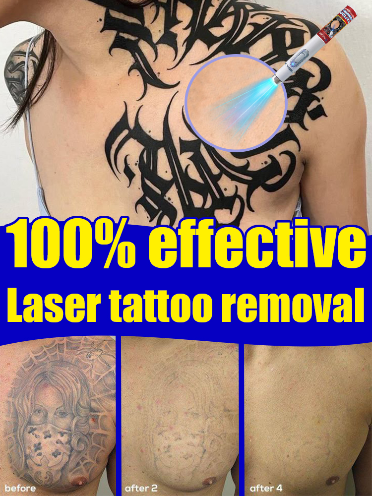 ᴀʟʟ ᴛᴀᴛᴛᴏᴏs Nano laser removes all tattoosᴺᵃⁿᵒ ˡᵃˢᵉʳ ʳᵉᵐᵒᵛᵉˢ ᵃˡˡ ᵗᵃᵗᵗᵒᵒˢ