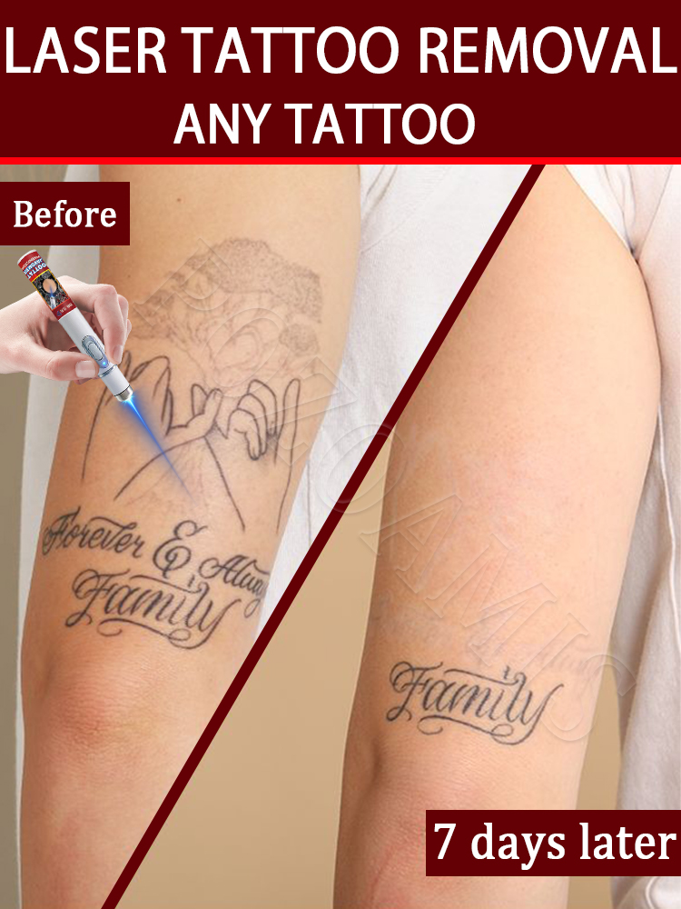Nano laser tattooʀᴇᴍᴏᴠᴀʟ ᴘᴇɴ: Highly effective at removing pigmentation, faster recovery. Enjoy salon-quality technolo